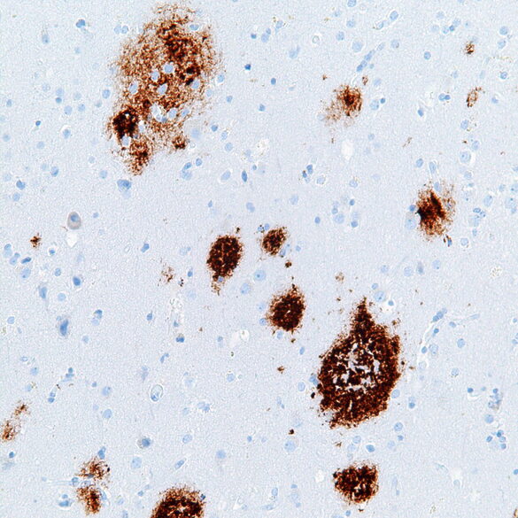 Plaques séniles composés de protéines beta amyloïdes, Alzheimer