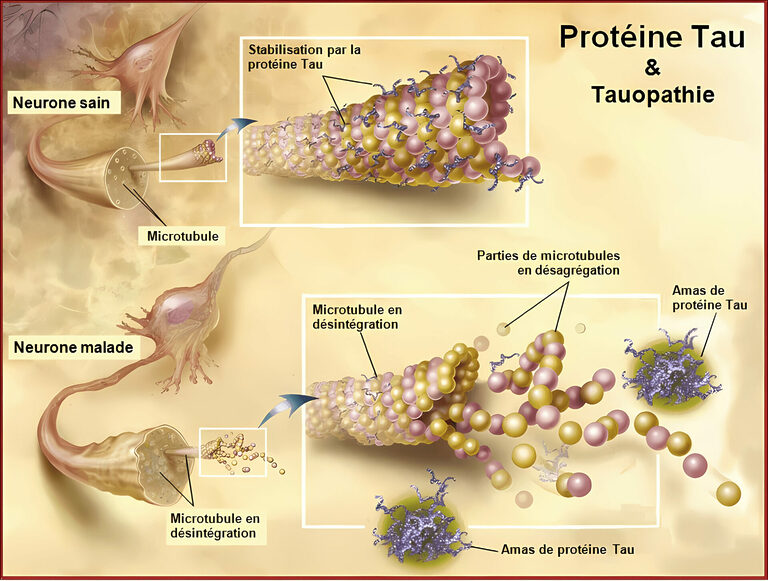 Protéines tau, Alzheimer